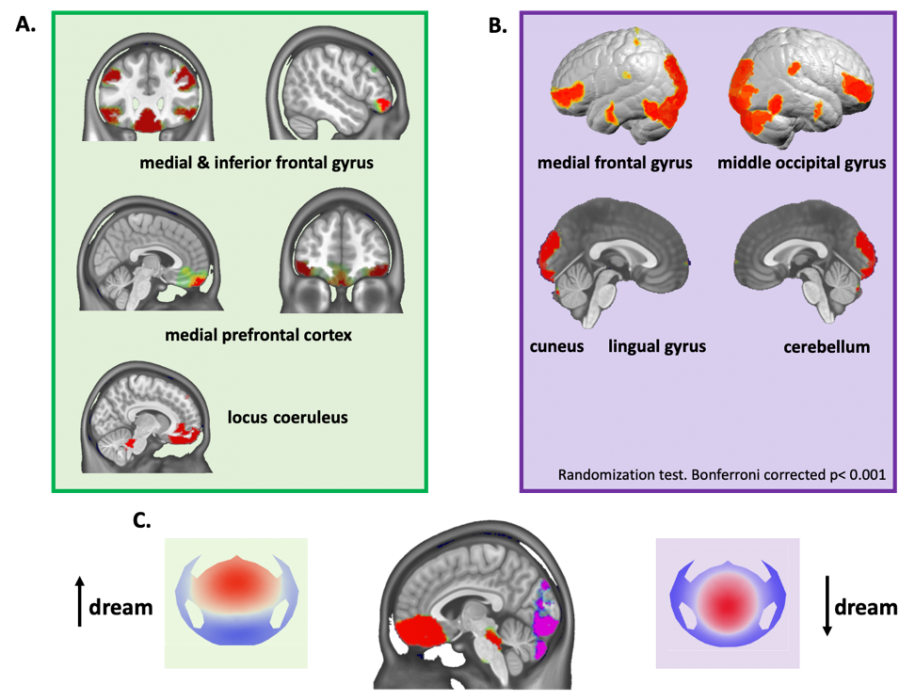 EEG Microstates Of Dreams - CIBM | Center For Biomedical Imaging